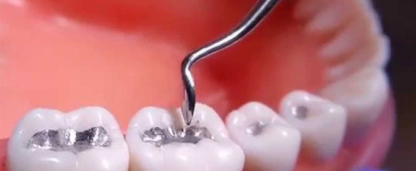 Dental Amalgam Removal: Important Oral Health Considerations