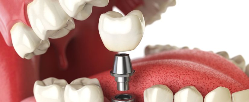 The Reliability of Dental Implants