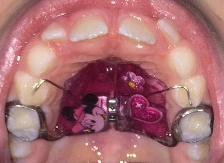 Palate expansion