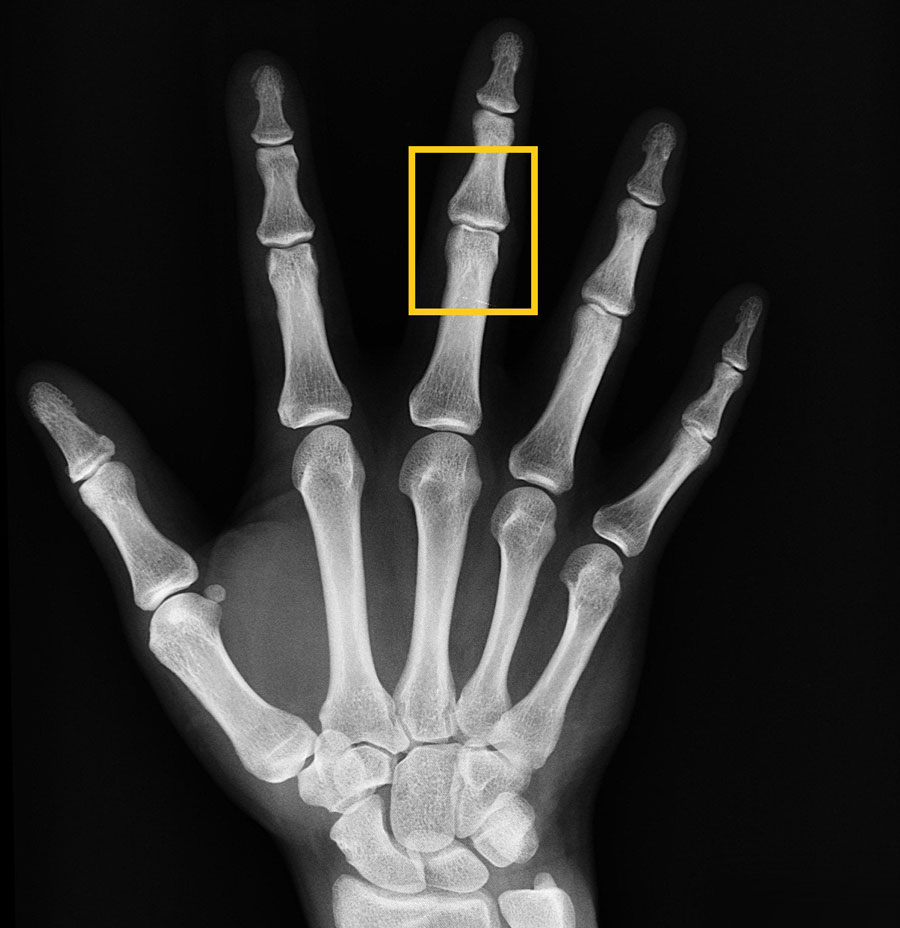tercera falange del dedo medio de la mano 