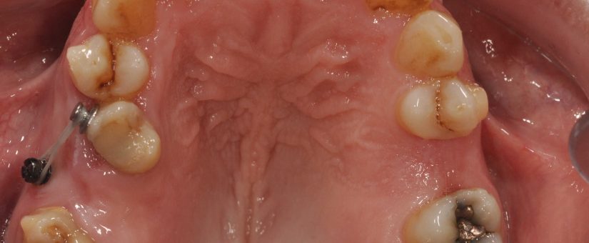 Microscrews in Orthodontics: A Revolution in the Treatment of Malocclusions