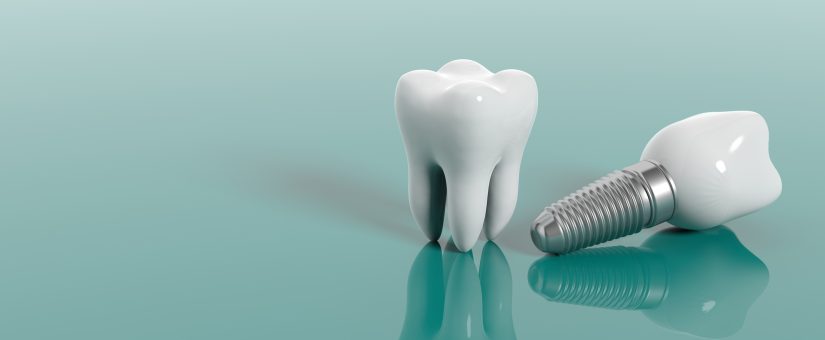 The Quality of Titanium and its Importance in the Manufacturing of Dental Implants