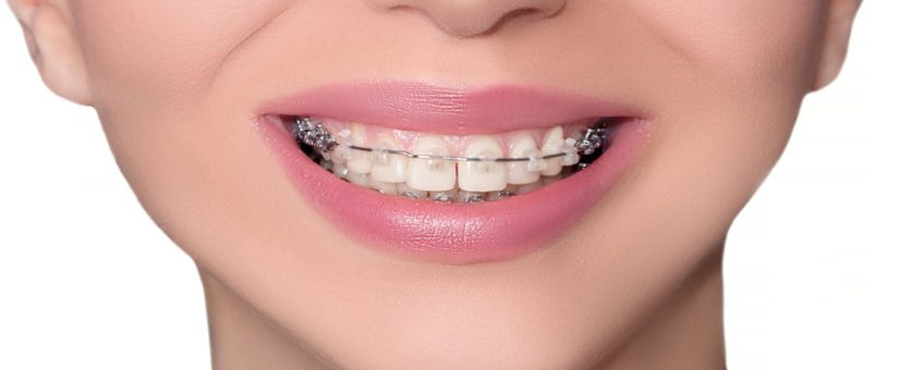 DENTAL RETENTION AFTER ORTHODONTIC TREATMENT