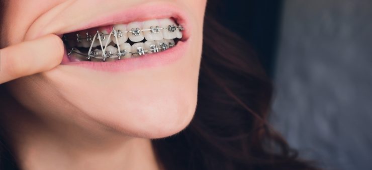 The use of intraoral elastics in orthodontics