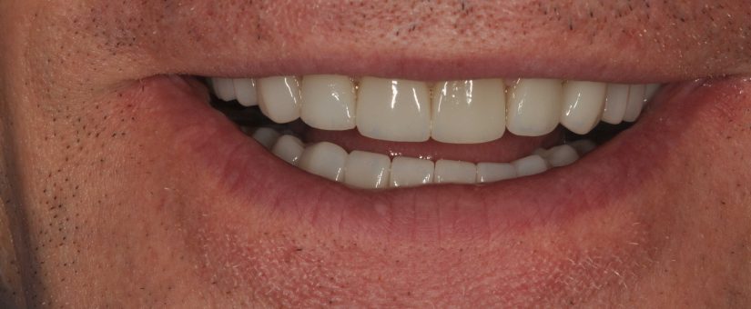 Ceramic Veneers in Dentistry: Embellishment and Dental Restoration